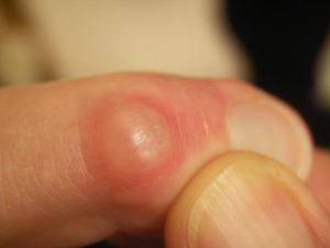 Симптомы и лечение наростов на пальцах ног