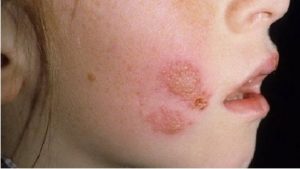 Симптомы и лечение мокнущего дерматита