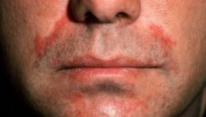 Симптомы и лечение перорального дерматита на лице