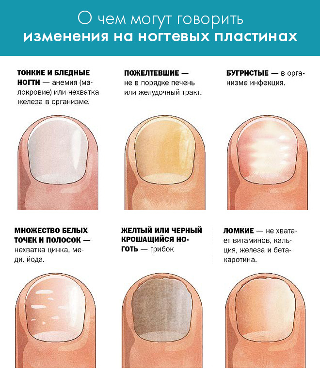 инфографика - заболевания в зависимости от цвета ногтей