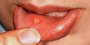 Симптомы и лечение герпеса на слизистой оболочке рта