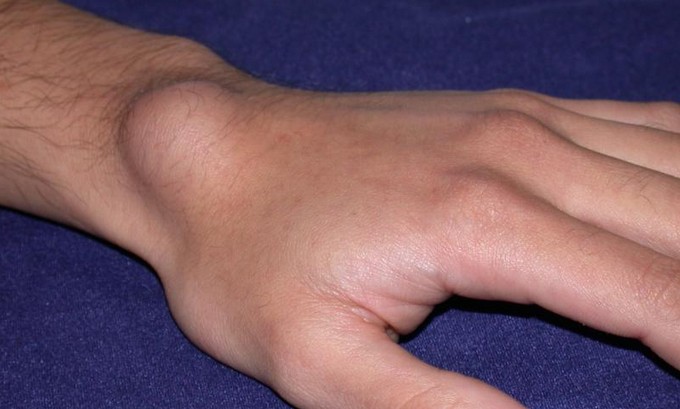 Методы лечения кисты на руке