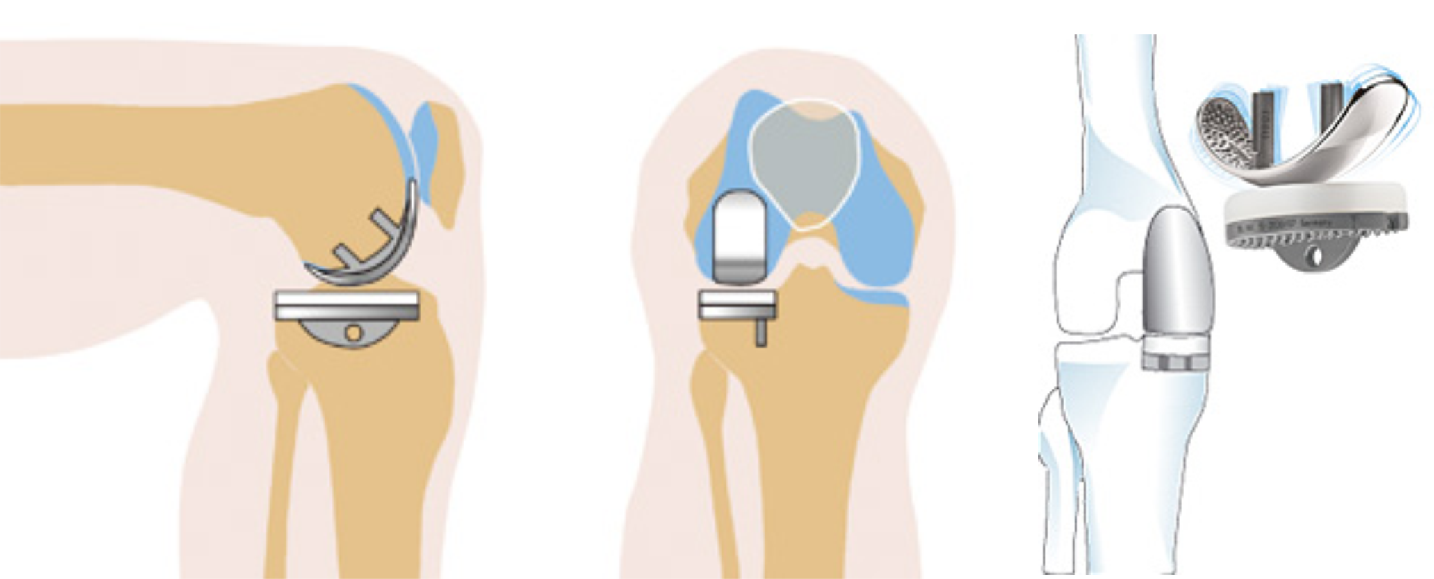 Бесплатная замена коленного сустава. Модульный эндопротез коленного сустава цито. Одномыщелковое эндопротезирование коленного сустава. Схема эндопротеза коленного сустава. Эндопротез коленного сустава операция.