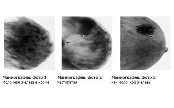 рак и мастопатия на снимке
