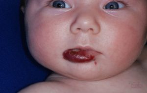 гемангиомы на губе у взрослых