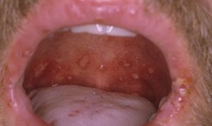 сыпи на слизистой полости рта