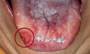сыпи на слизистой полости рта
