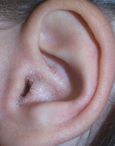 лечить фурункул наружного слухового прохода