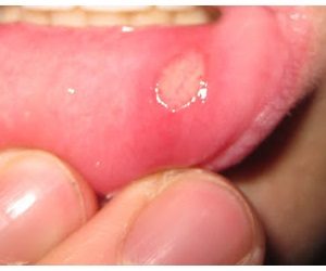 лечение герпеса на внутренней стороне губы 