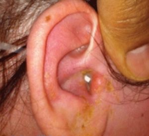 Как нужно лечить отомикоз ушей