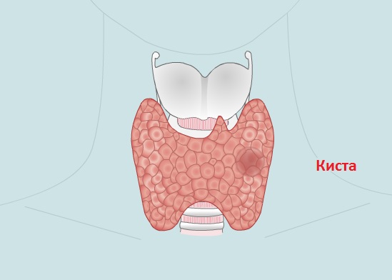 Почему возникают коллоидные кисты щитовидной железы