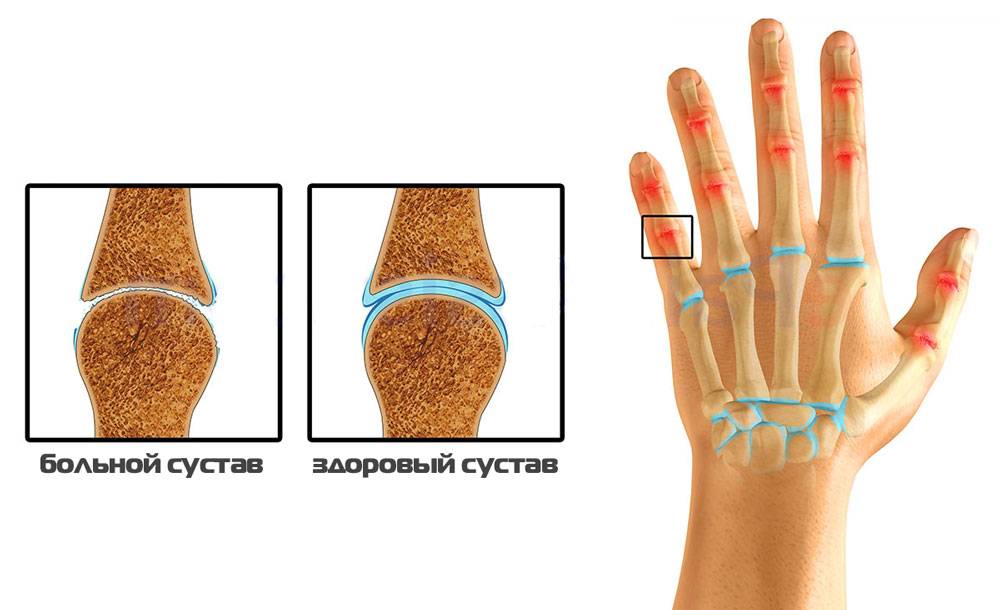Артроз суставов пальцев