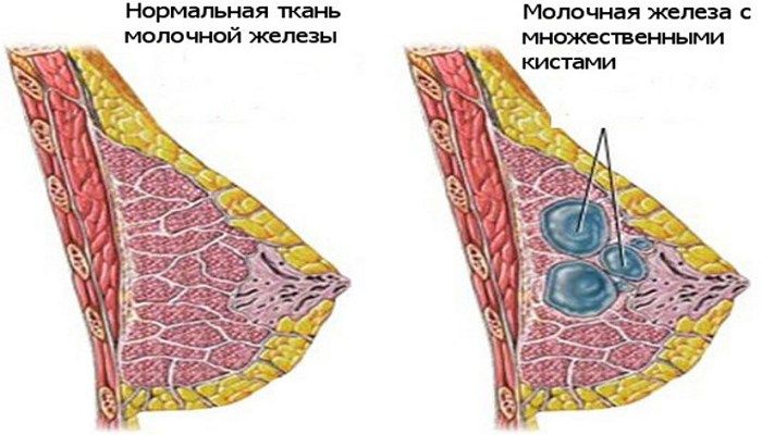 Ткань молочной железы. Эктазия протоков молочной железы. Уплотнения в грудных железах. Образование под молочной железой. Застой в молочных железах.