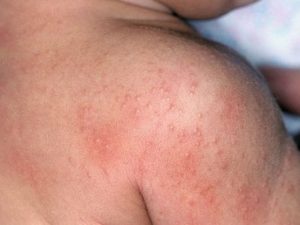 Симптомы и лечение токсико-аллергического дерматита