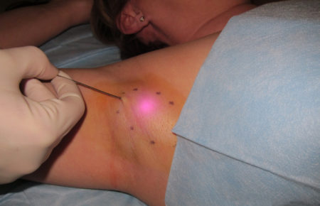 Лазерная терапия повышенного потоотделения в области подмышечных впадин