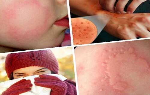 аллергии на коже у взрослых и детей