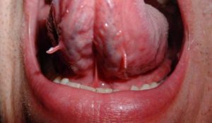лечение папилломы во рту