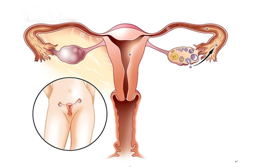Что такое киста яичника у женщин