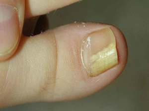 Как вылечить грибок ногтей