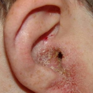 Как и чем лечить отомикоз уха