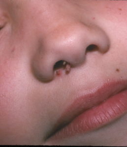 Симптомы и лечение папилломы на носу