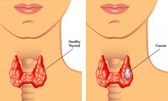 Симптомы и лечение кисты на щитовидной железе
