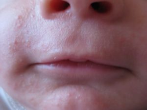 Причины появления сыпи вокруг рта ребенка и методы борьбы с ними