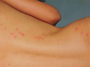 симптомы комариных укусов