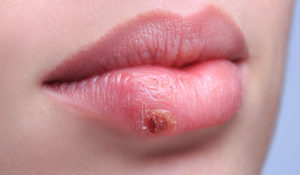 герпес часто появляется на губах