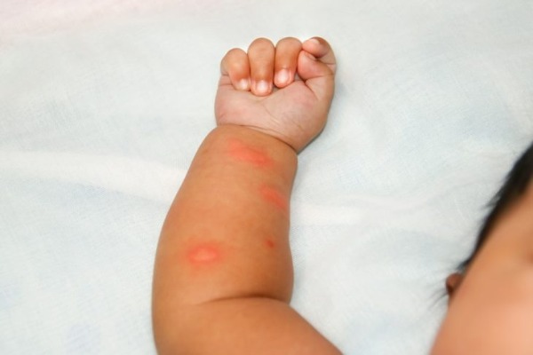 проявления аллергии у ребенка