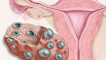 Что такое кистозные изменения яичников