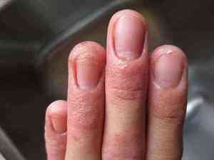Признаки грибка пальцев рук