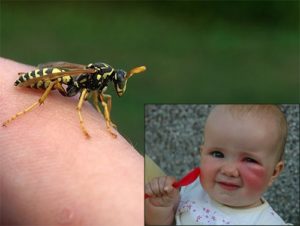 аллергия у ребенка от укуса пчелы