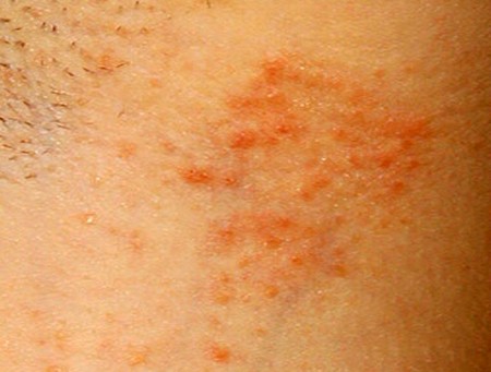 Аллергия на пот в подмышечной впадине