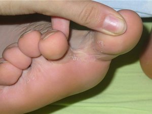 Заболевание грибок ног