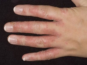 Симптомы грибка между пальцами рук