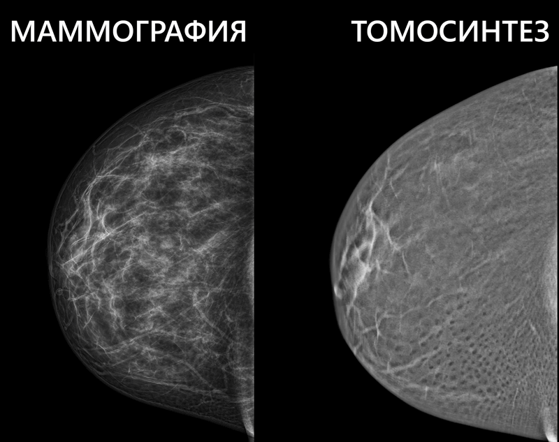 маммография с фотосинтезом