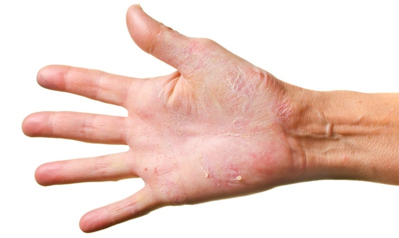 Какими способами лечить грибок рук