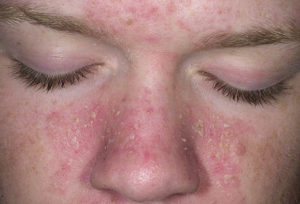 Чем и как можно лечить себорейный дерматит на лице