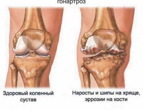 Заболевание коленного сустава