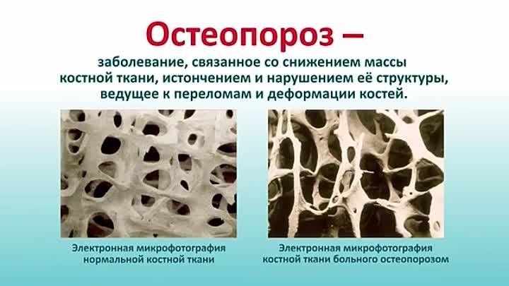 Разряжение костной ткани. Заболевания костной ткани. Разрушение костной ткани.