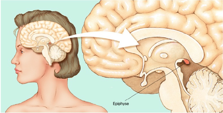 Киста шишковидной железы (эпифиза) головного мозга