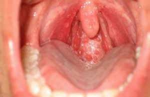 Герпес на слизистой рта – проявления и лечение