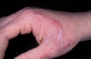 Симптомы и лечение наростов на коже