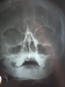 рентген пазух носа