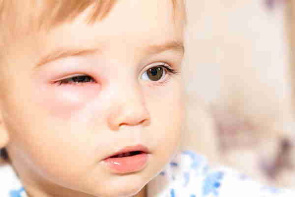аллергическая реакция у ребенка
