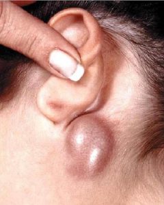 Что делать, если появилась шишка на мочке уха