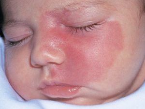 гемангиома на лице у ребенка