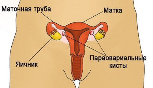 Что такое параовариальная киста на яичнике