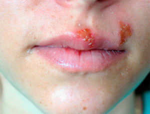 герпес часто появляется на губах